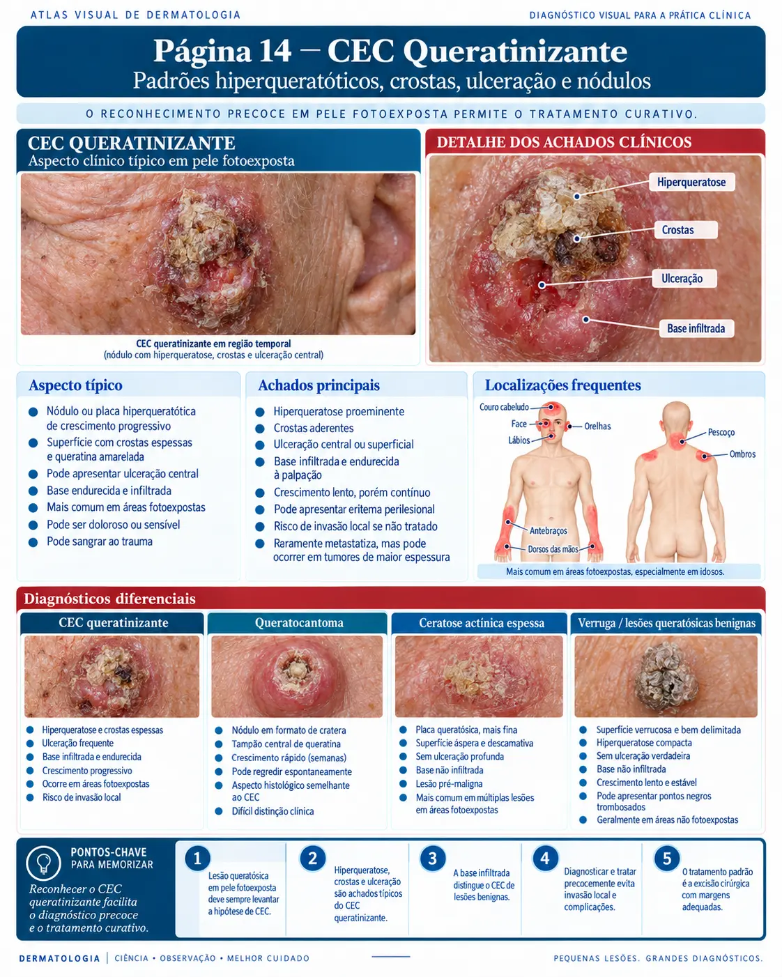 Página do ATLAS VISUAL DE CÂNCER DE PELE: CEC Queratinizante